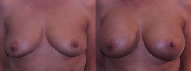 A result from Westfield Plastic Surgery Center