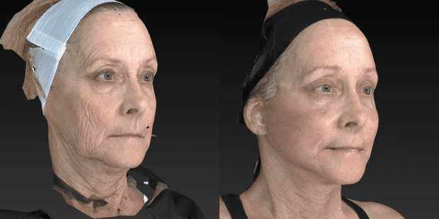 A result from Westfield Plastic Surgery Center