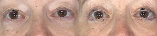 A result from Westfield Plastic Surgery Center