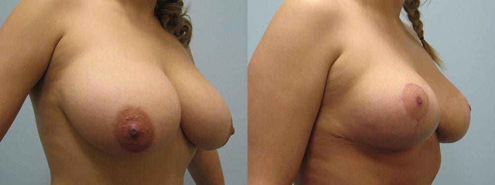 A result from Westfield Plastic Surgery Center