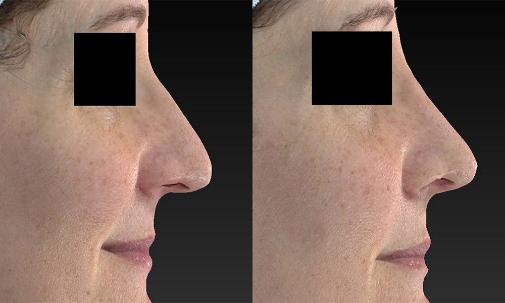 A result from Westfield Plastic Surgery Center