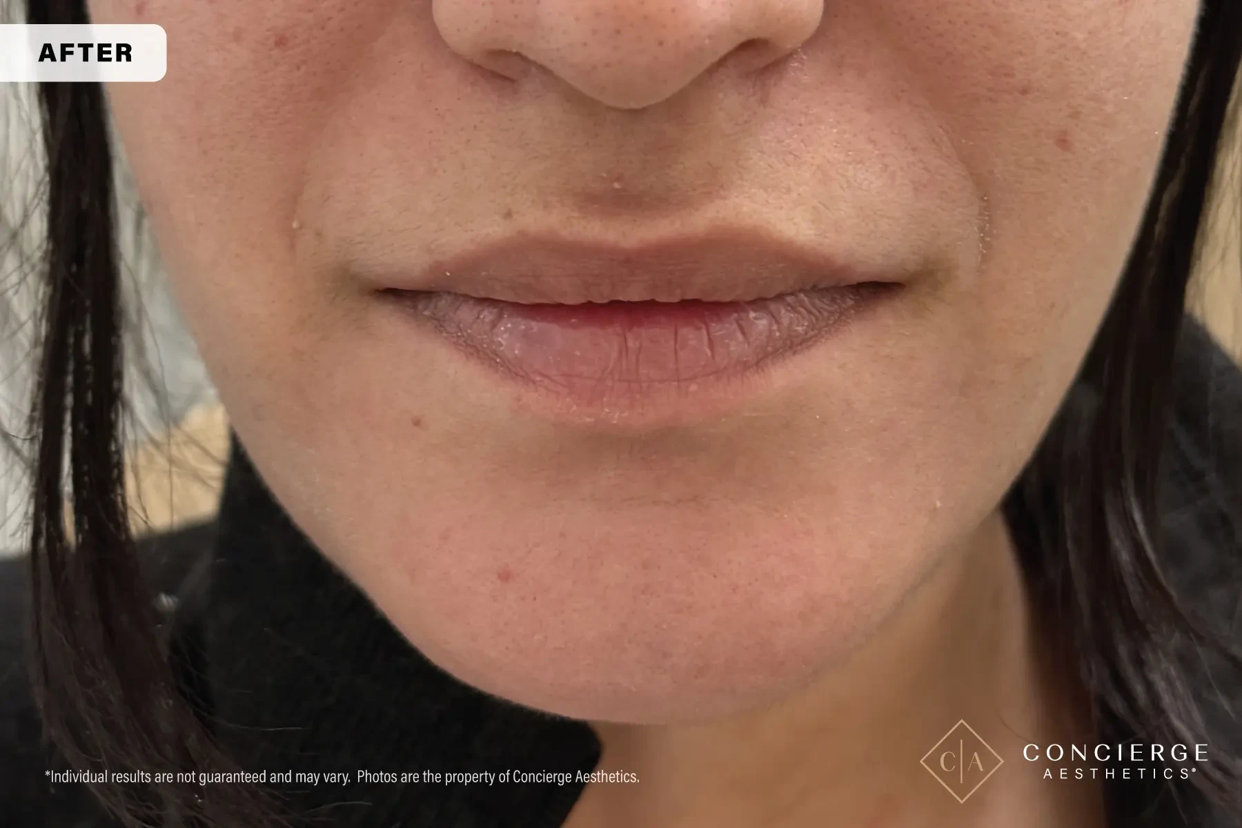 A result from Concierge Aesthetics® - Botox, Dysport, CoolPeel, Juvederm, Laser, Morpheus8, Restylane, Xeomin