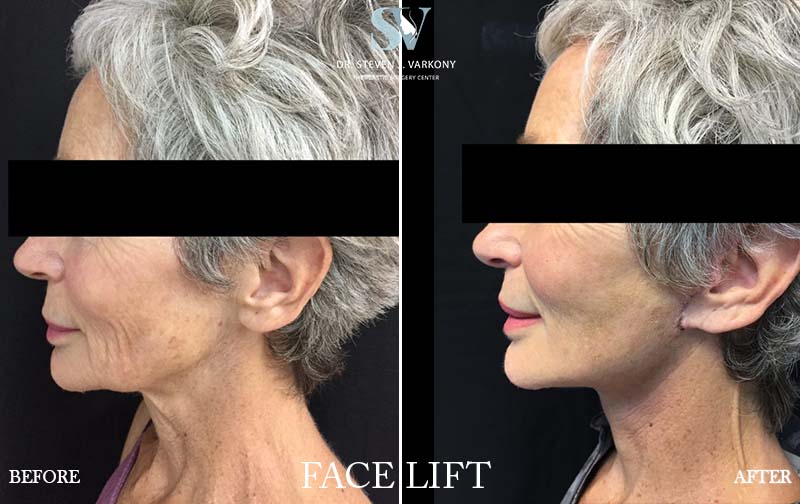 Facelift result at Encino Plastic Surgery Center