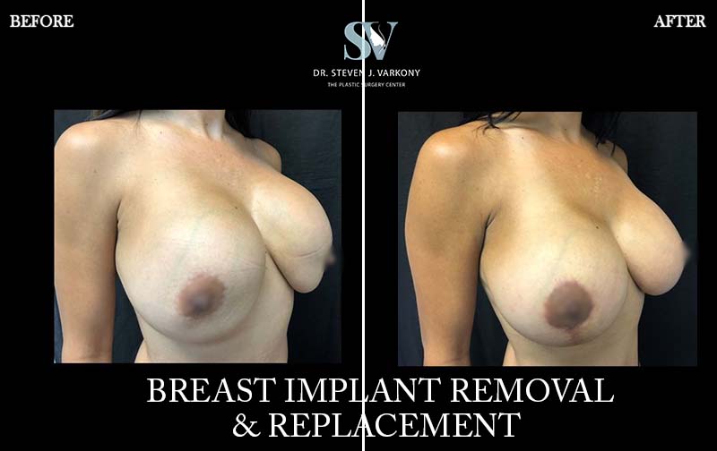 Breast Augmentation result at Encino Plastic Surgery Center