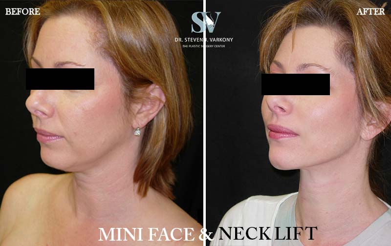 Facelift result at Encino Plastic Surgery Center