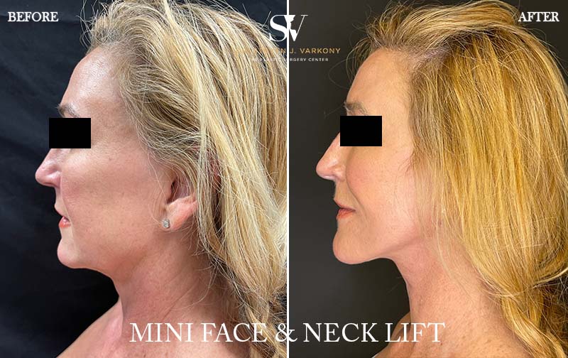Facelift result at Encino Plastic Surgery Center