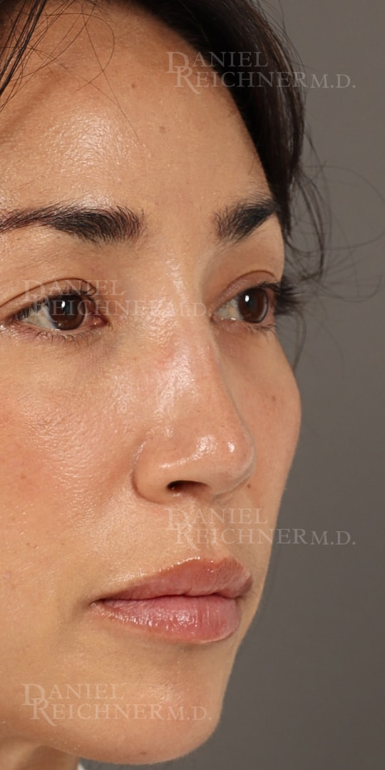 A result from Daniel Reichner, MD, FACS