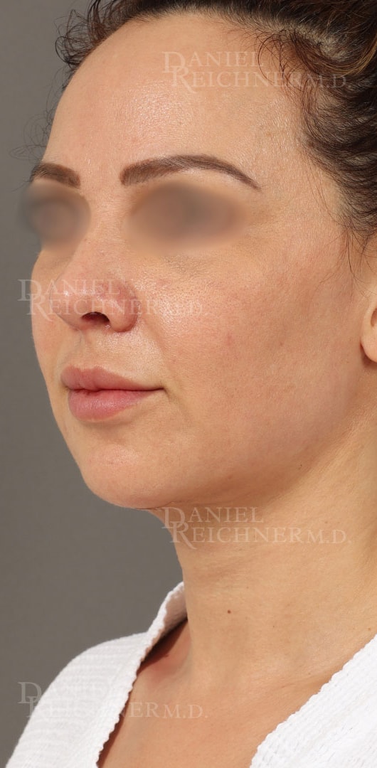A result from Daniel Reichner, MD, FACS