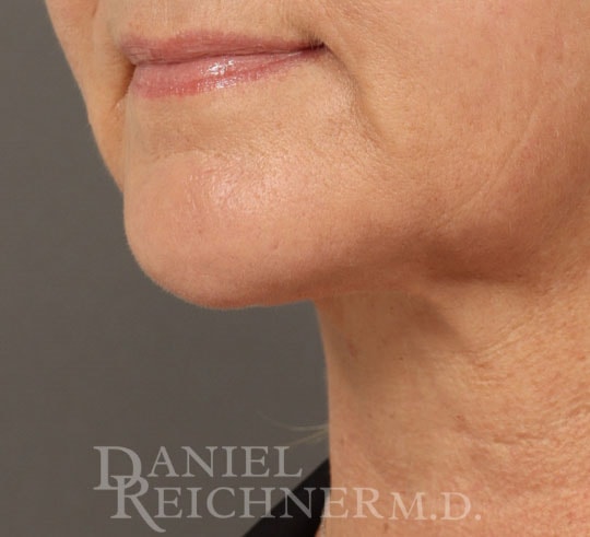 A result from Daniel Reichner, MD, FACS