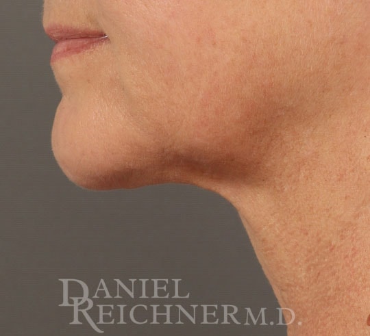 A result from Daniel Reichner, MD, FACS