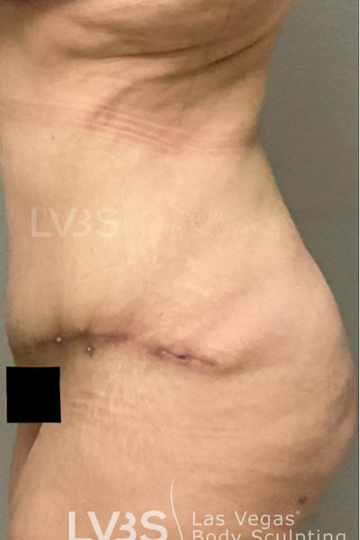 Liposuction result at Las Vegas Body Sculpting