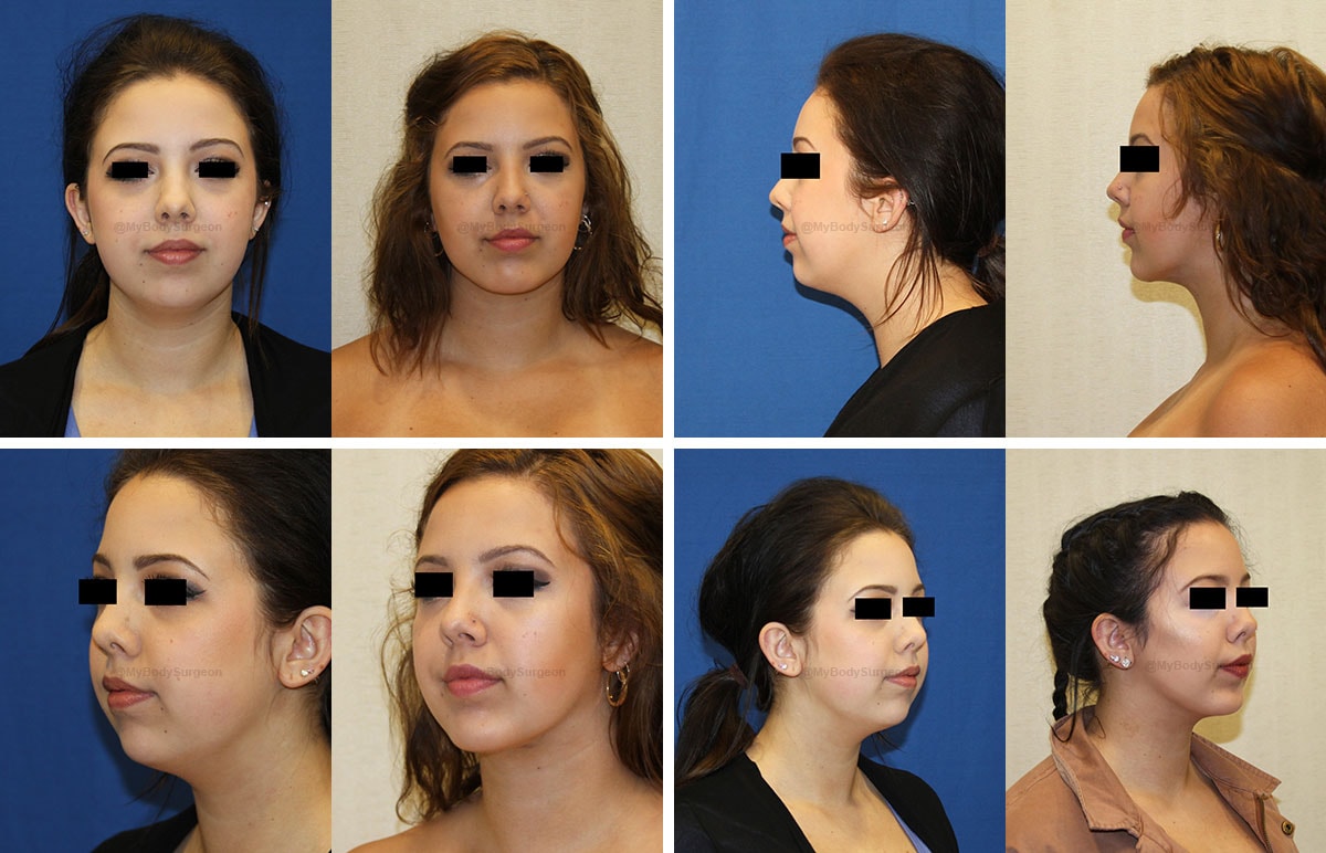 A result from Sugar Land Plastic Surgery