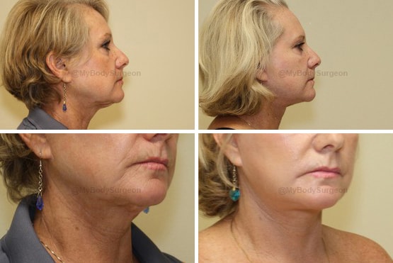 A result from Sugar Land Plastic Surgery