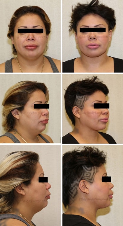 A result from Sugar Land Plastic Surgery
