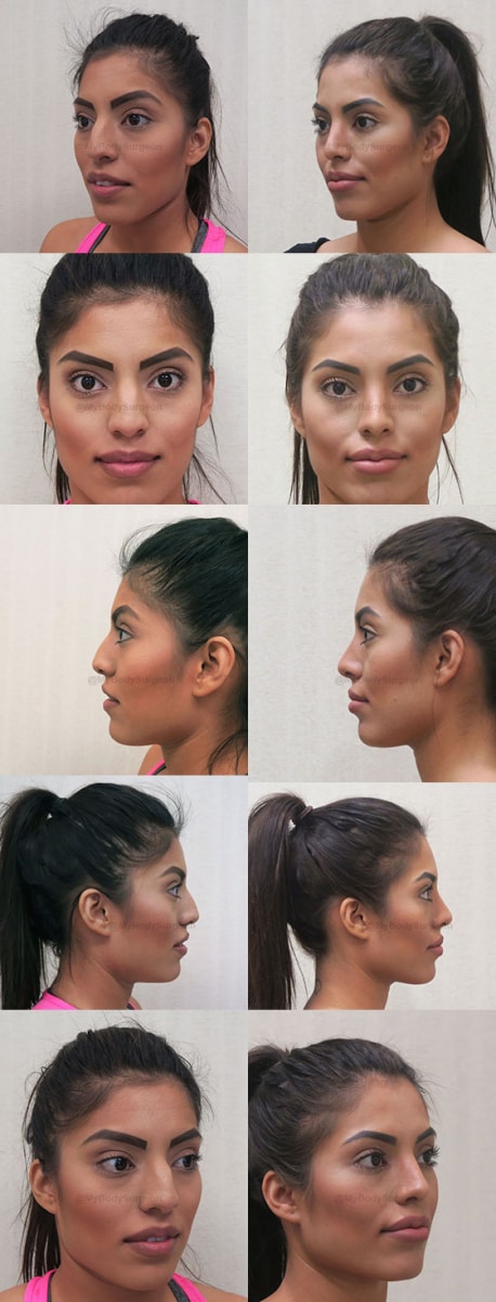 A result from Sugar Land Plastic Surgery