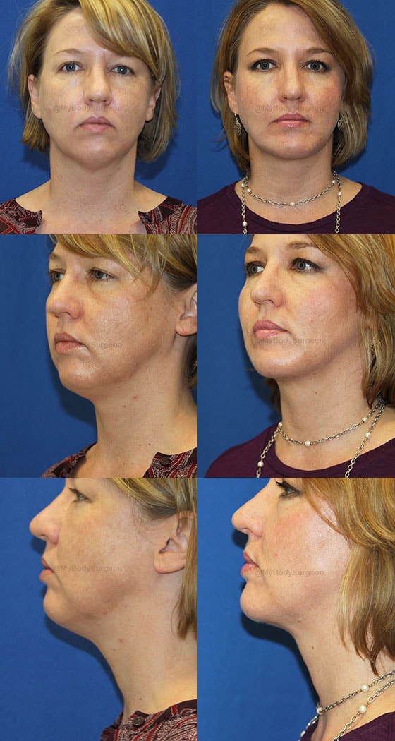 A result from Sugar Land Plastic Surgery