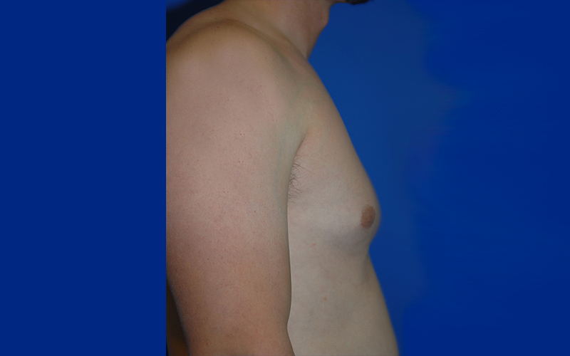 Gynecomastia before photo