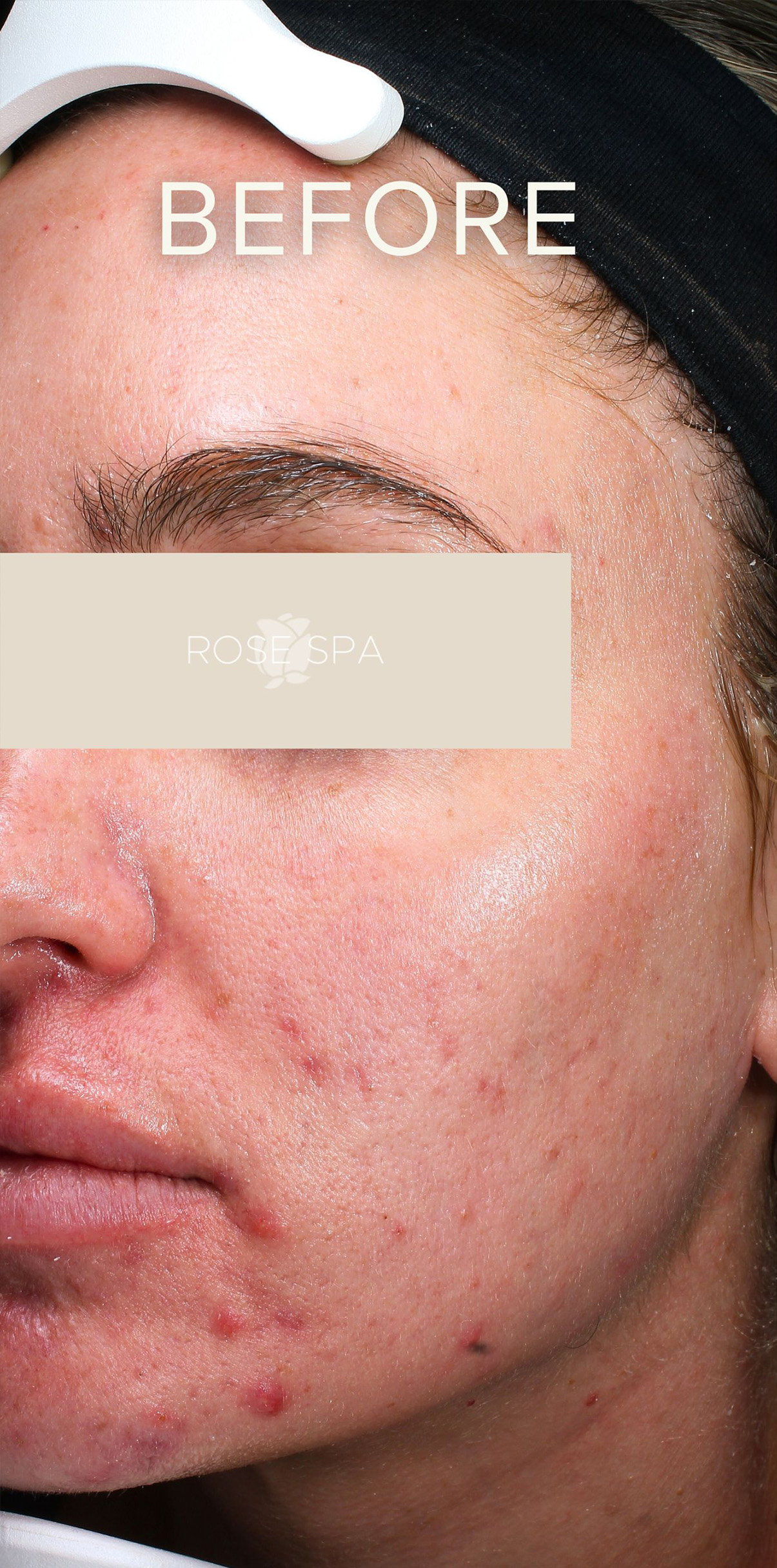Laser Treatment before photo
