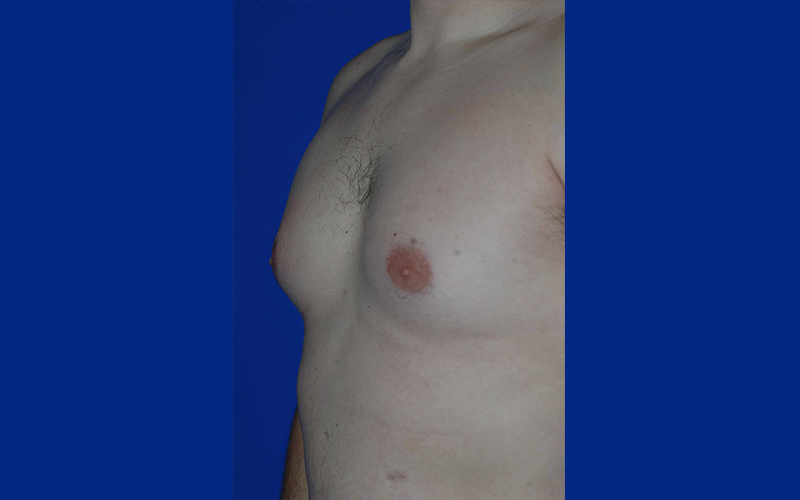 Gynecomastia before photo