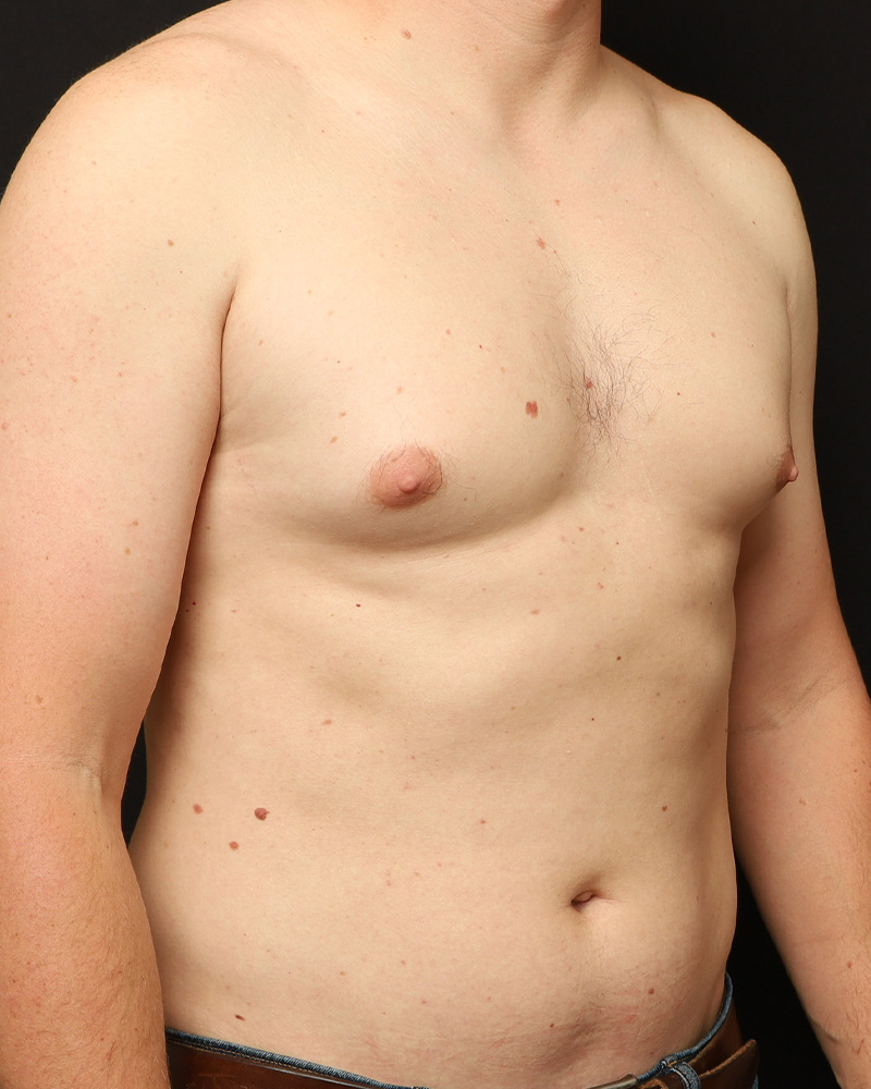 Liposuction before photo