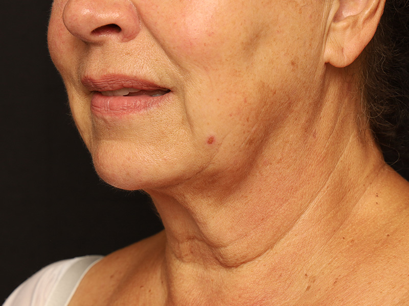 Skin Tightening before photo