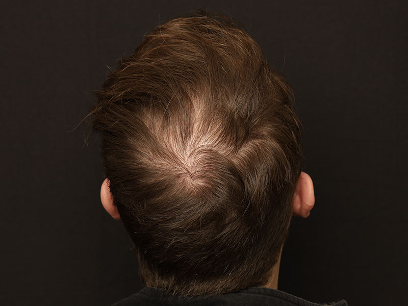 Fue Transplant before photo