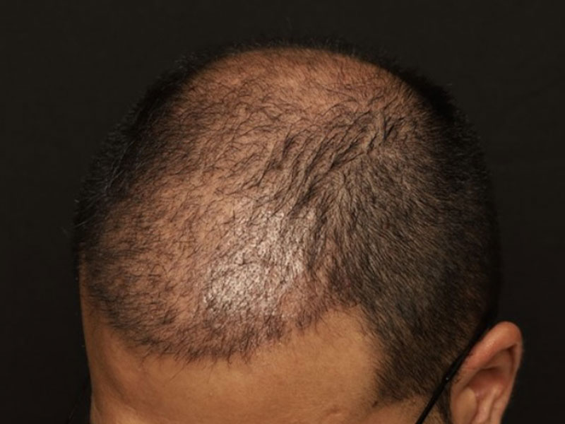 Fue Transplant before photo