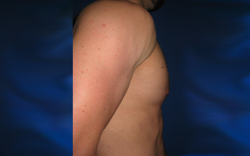 Gynecomastia before photo