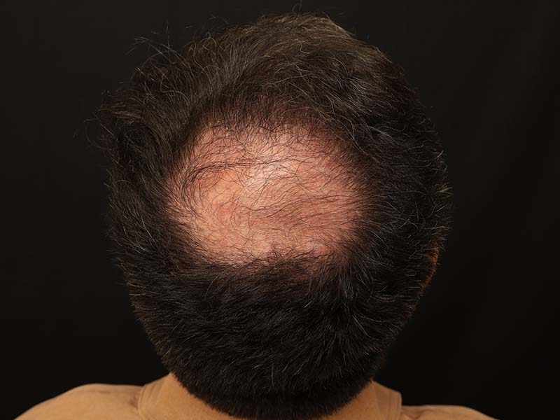 Fue Transplant before photo