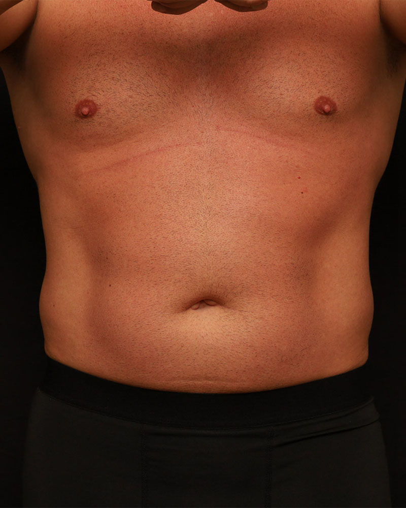 Liposuction before photo
