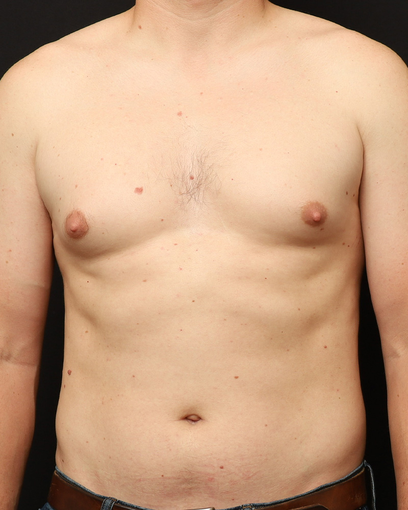 Liposuction before photo