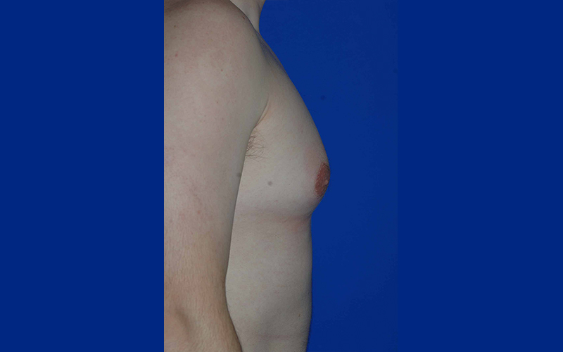 Gynecomastia before photo