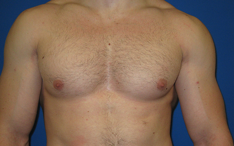 Gynecomastia before photo