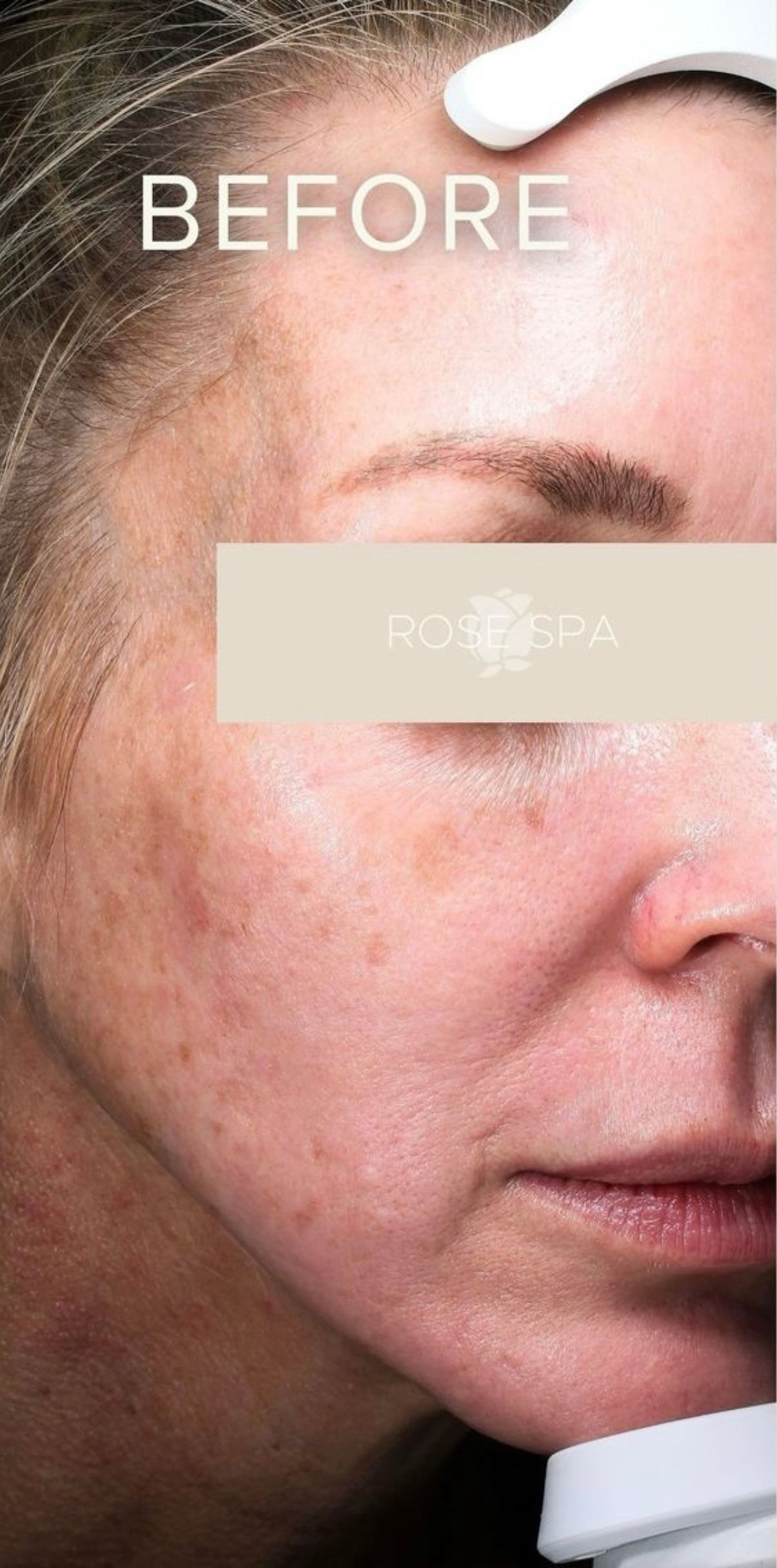 Laser Treatment before photo