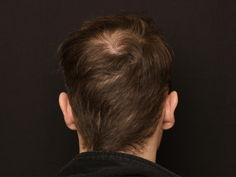 Fue Transplant before photo