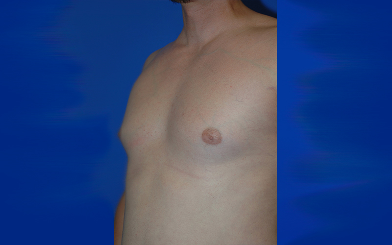 Gynecomastia before photo