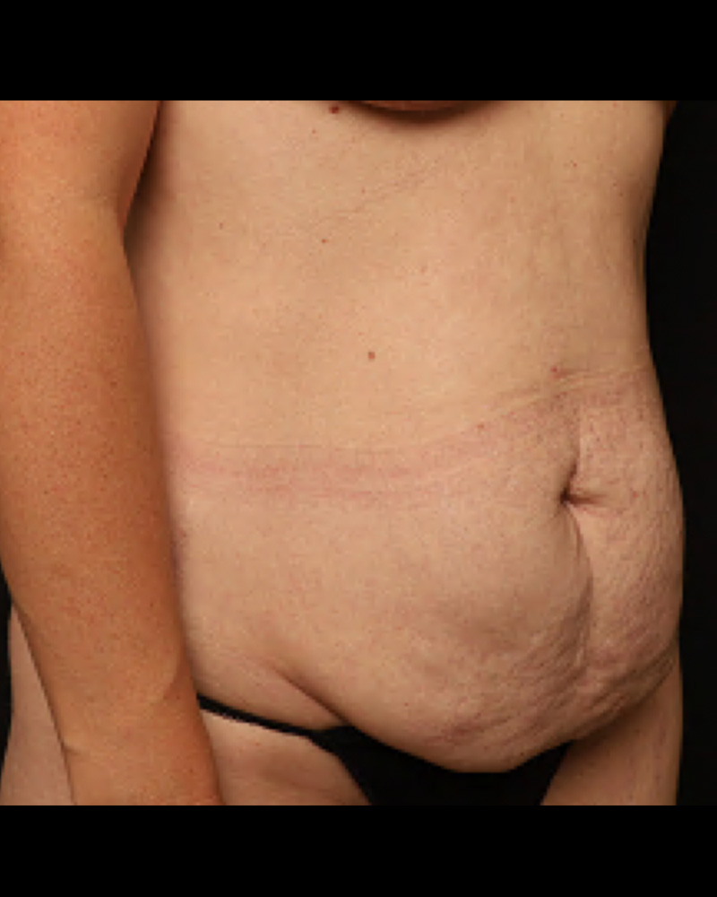 Tummy Tuck before photo