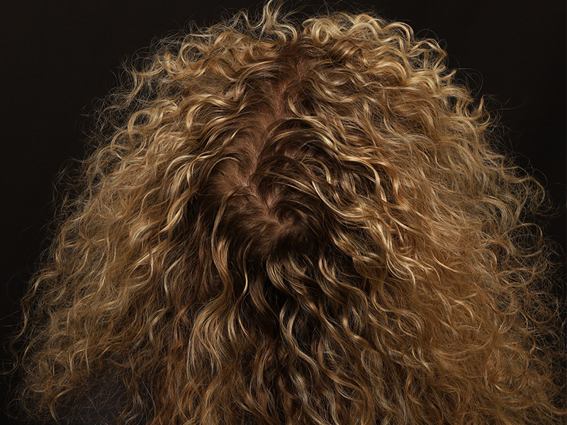 Fue Transplant before photo