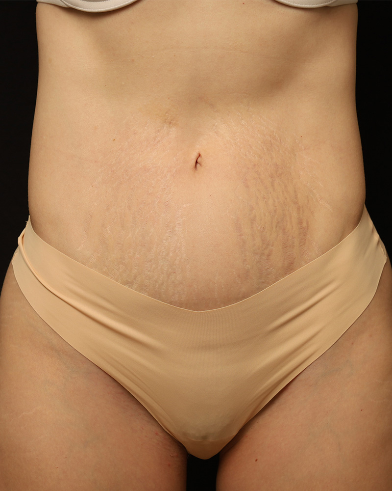Tummy Tuck before photo