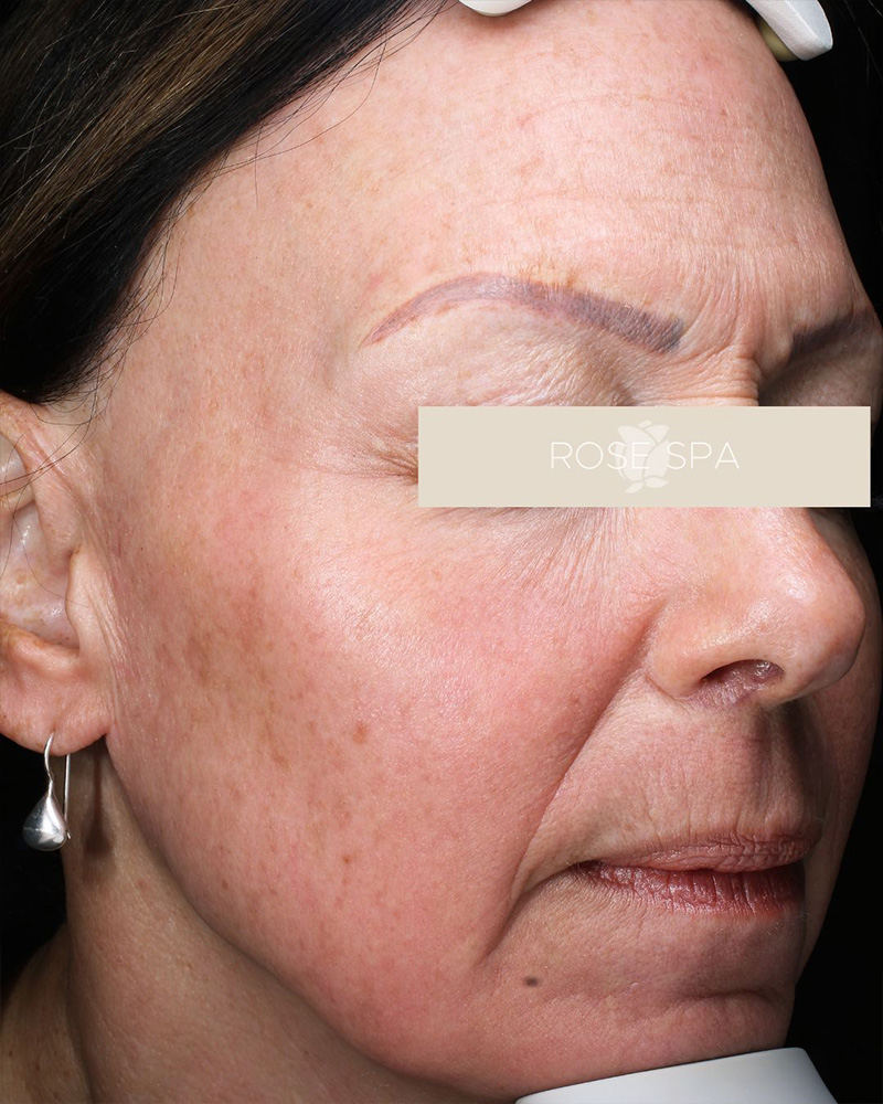 Laser Treatment before photo