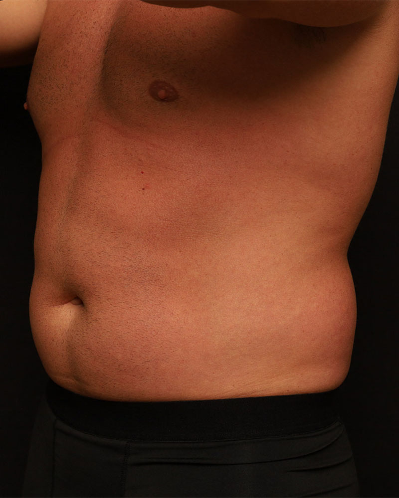 Liposuction before photo