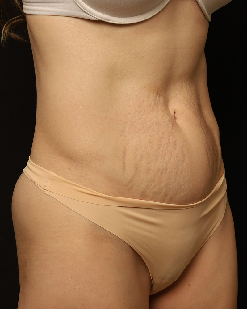 Tummy Tuck before photo