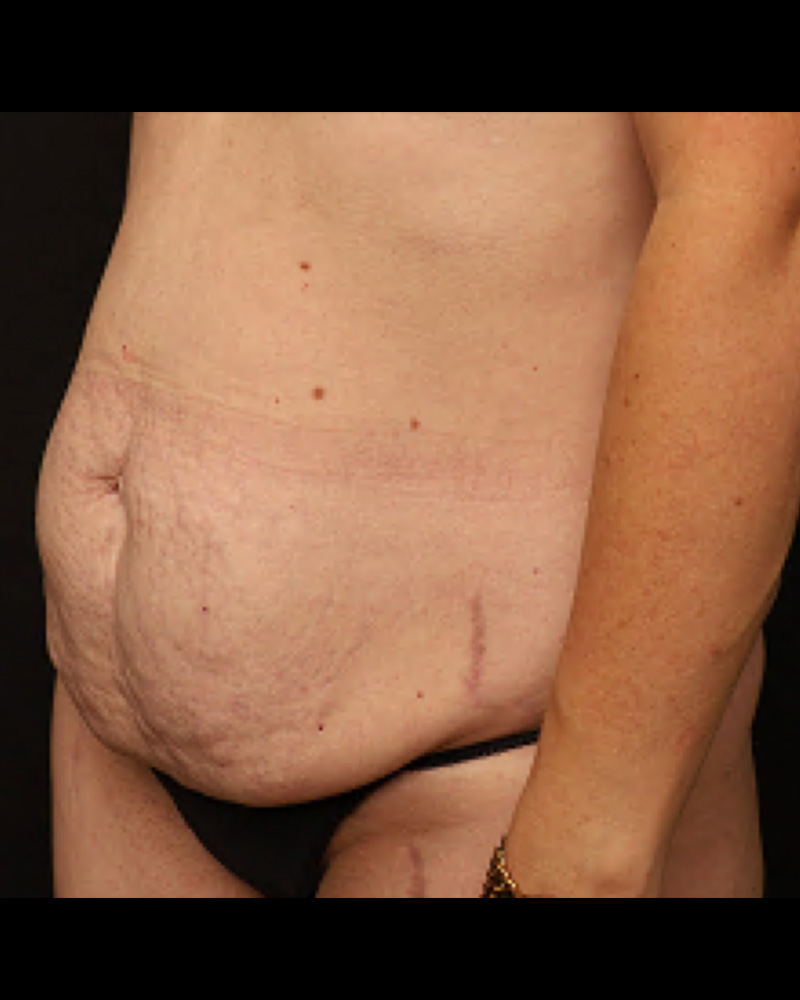 Tummy Tuck before photo