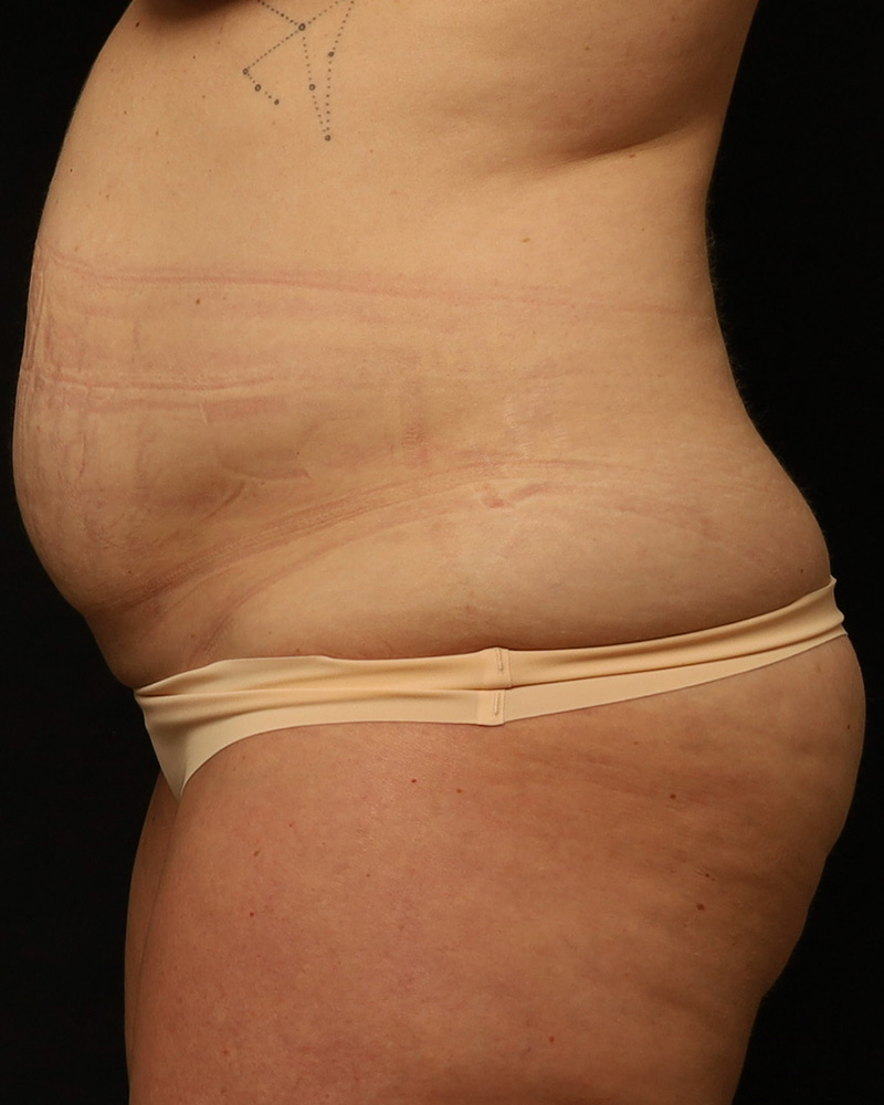 Tummy Tuck before photo