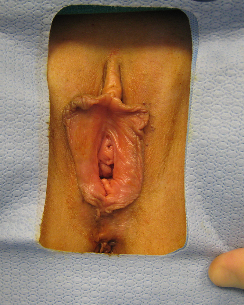 Labiaplasty before photo