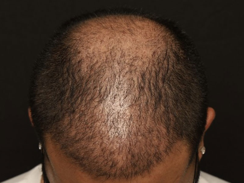 Fue Transplant before photo