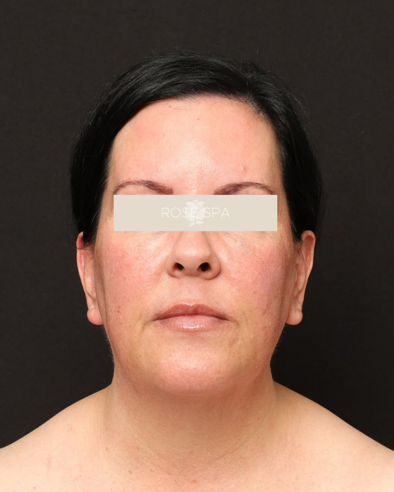 Laser Treatment before photo