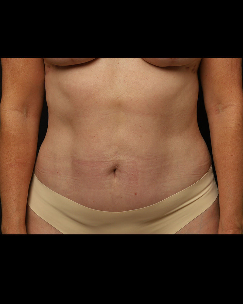 The Rose Clinic liposuction after — Salt Lake City, UT