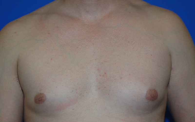 Gynecomastia before photo