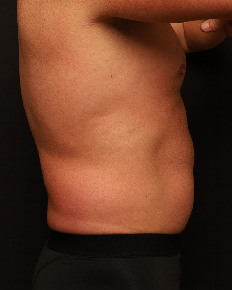 Liposuction before photo